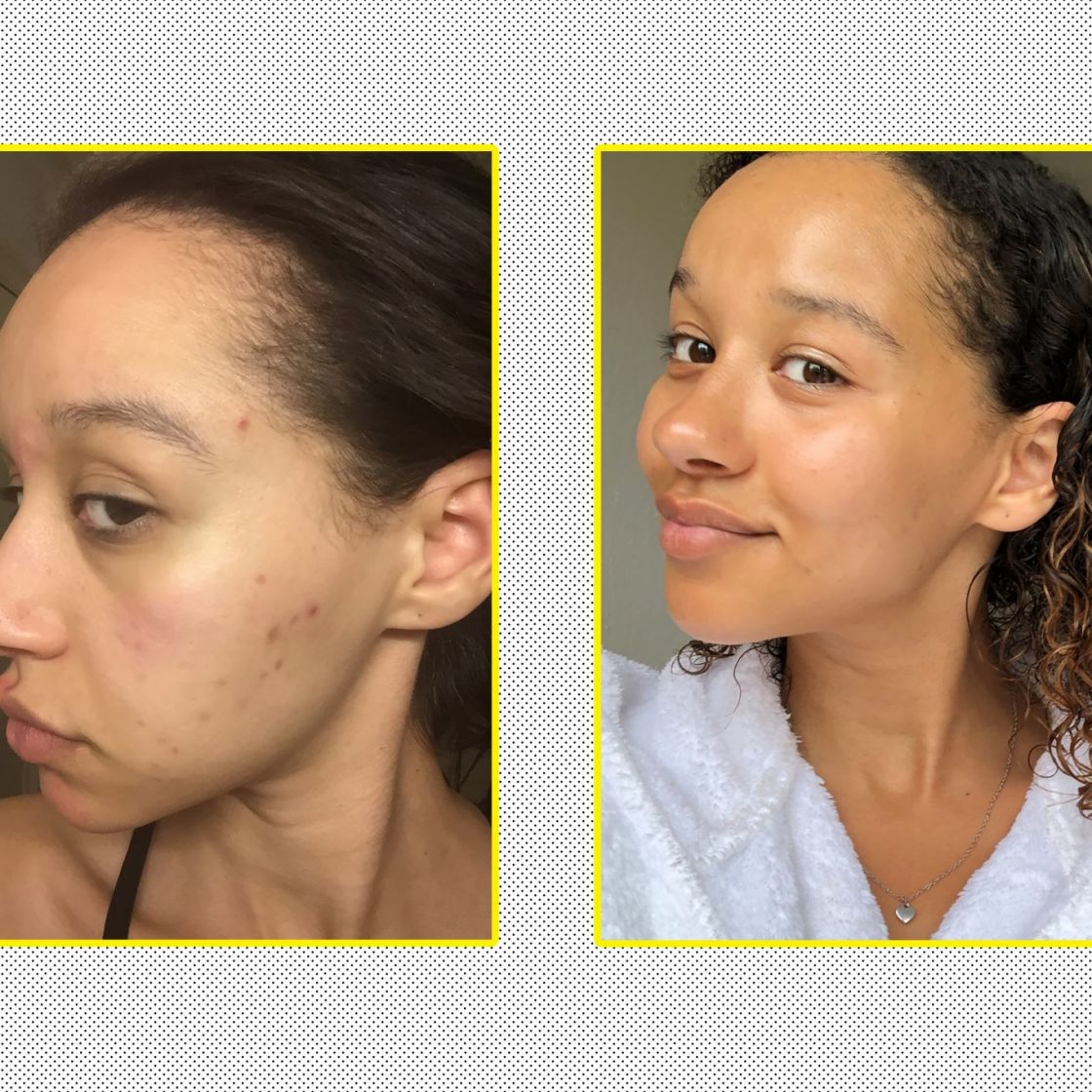 Buy Now - Choose your Premium Facial Clay Mask - (Green Tea, Turmeric or Dead Sea Mud) - Hydrating, Deep Cleansing of Pores, Oil Control, Blackhead Removal and Combat Wrinkles