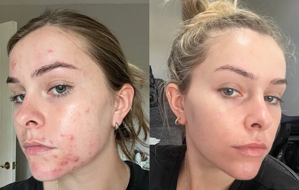 Choose Your Perfect Facial Clay Mask for Moisturizing, Blackhead Battles & Clear Skin